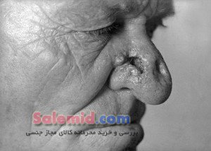 سیفلیس سفلیس باکتری مراحل درمان انتقال شانکر زخم بیماری تقلید پوست علائم ایدز